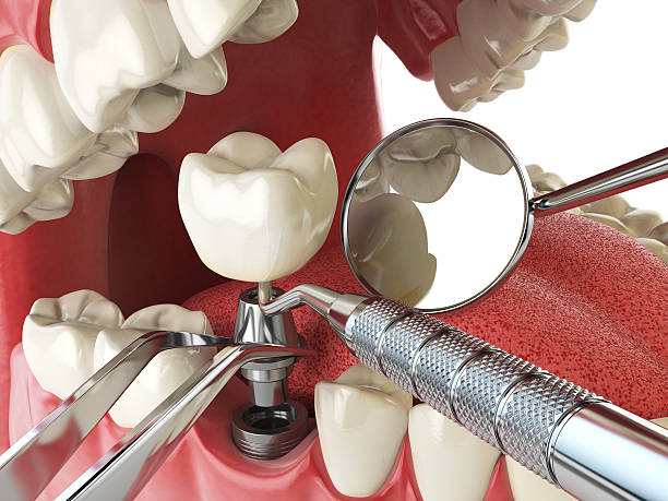 Best Emergency Denture Repair in Glasco, NY